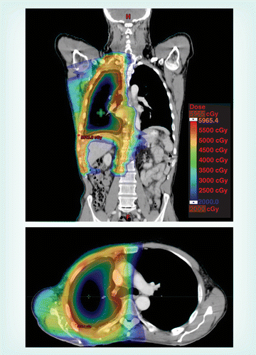 ct images of mesothelioma