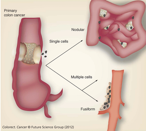 cancer colon metastatic