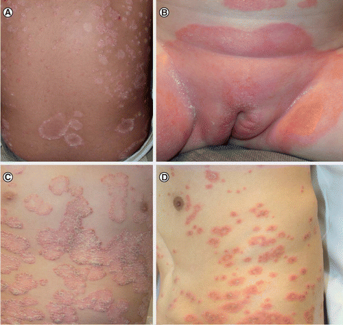 Dry itchy scalp psoriasis - chilijoga.hu