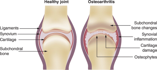 a fazett ízületek osteoarthritis)