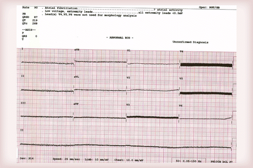 Prolonged Asystole In A Patient With An Isolated Left Ventricular Assist Device Future Cardiology