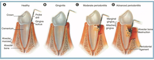 The gingipains: scissors and glue of the periodontal pathogen 