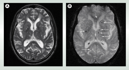Cerebral microbleeds: detection, mechanisms and clinical challenges