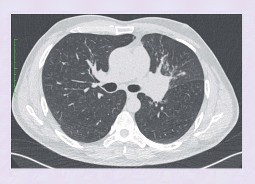 can radiation therapy cause lung cancer