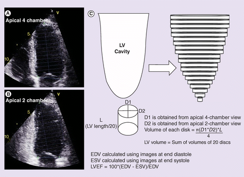 Study Demonstrates Strain Imaging Utility With Contrast-Echo Studies