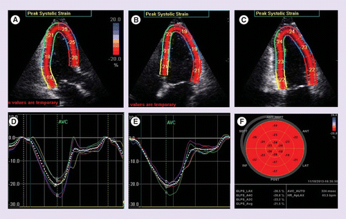 The use of myocardial strain and newer echocardiography imaging
