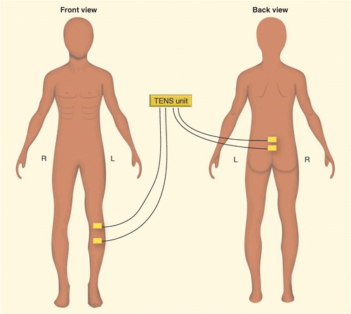 Transcutaneous electrical nerve stimulation for treatment of sarcoma cancer  pain
